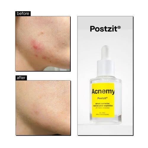 Освітлювальна сироватка для боротьби з постакне Acnemy Postzit 30 ml ACN1002 фото