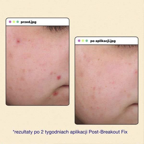 Dermalogica Clear Start Post Breakout Fix - Гель-крем для лікування плям після висипів DE1011 фото