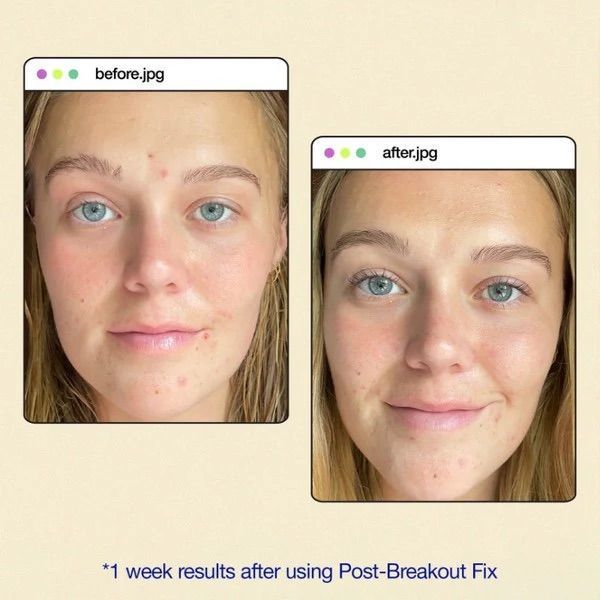 Dermalogica Clear Start Post Breakout Fix - Гель-крем для лікування плям після висипів DE1011 фото