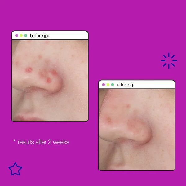 Dermalogica Clear Start Post Breakout Fix - Гель-крем для лікування плям після висипів DE1011 фото